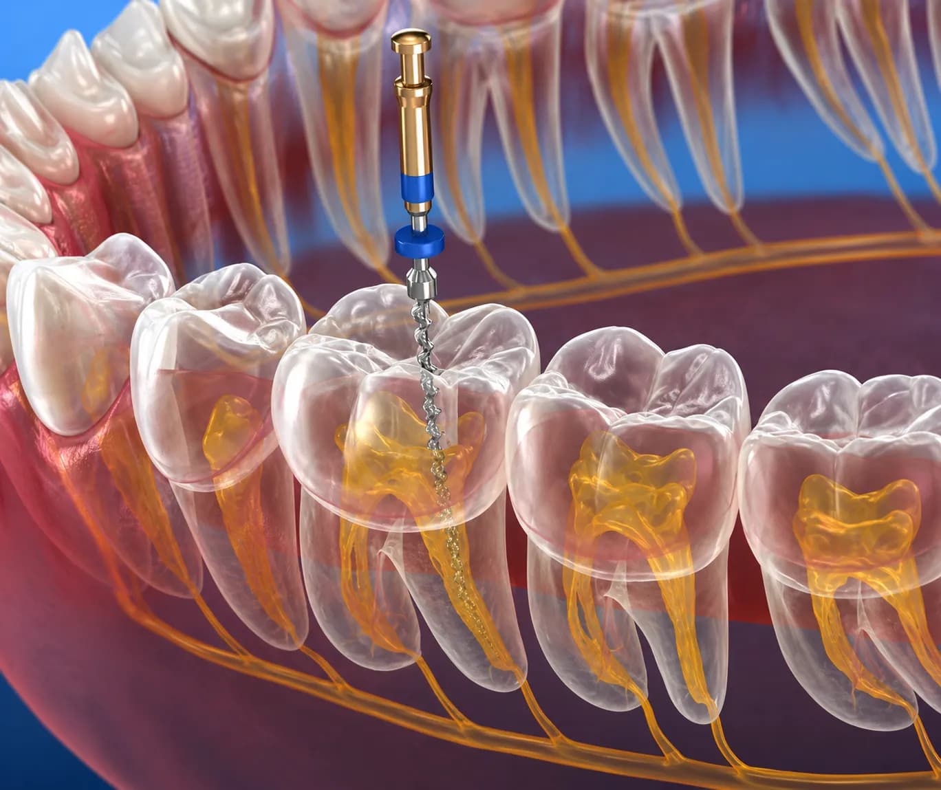 3D-Guided Root Canals