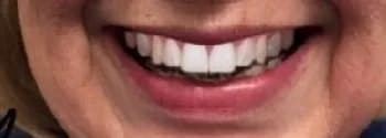 After: Complete Smile Transformation