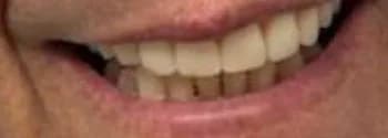 After: Porcelain Veneers
