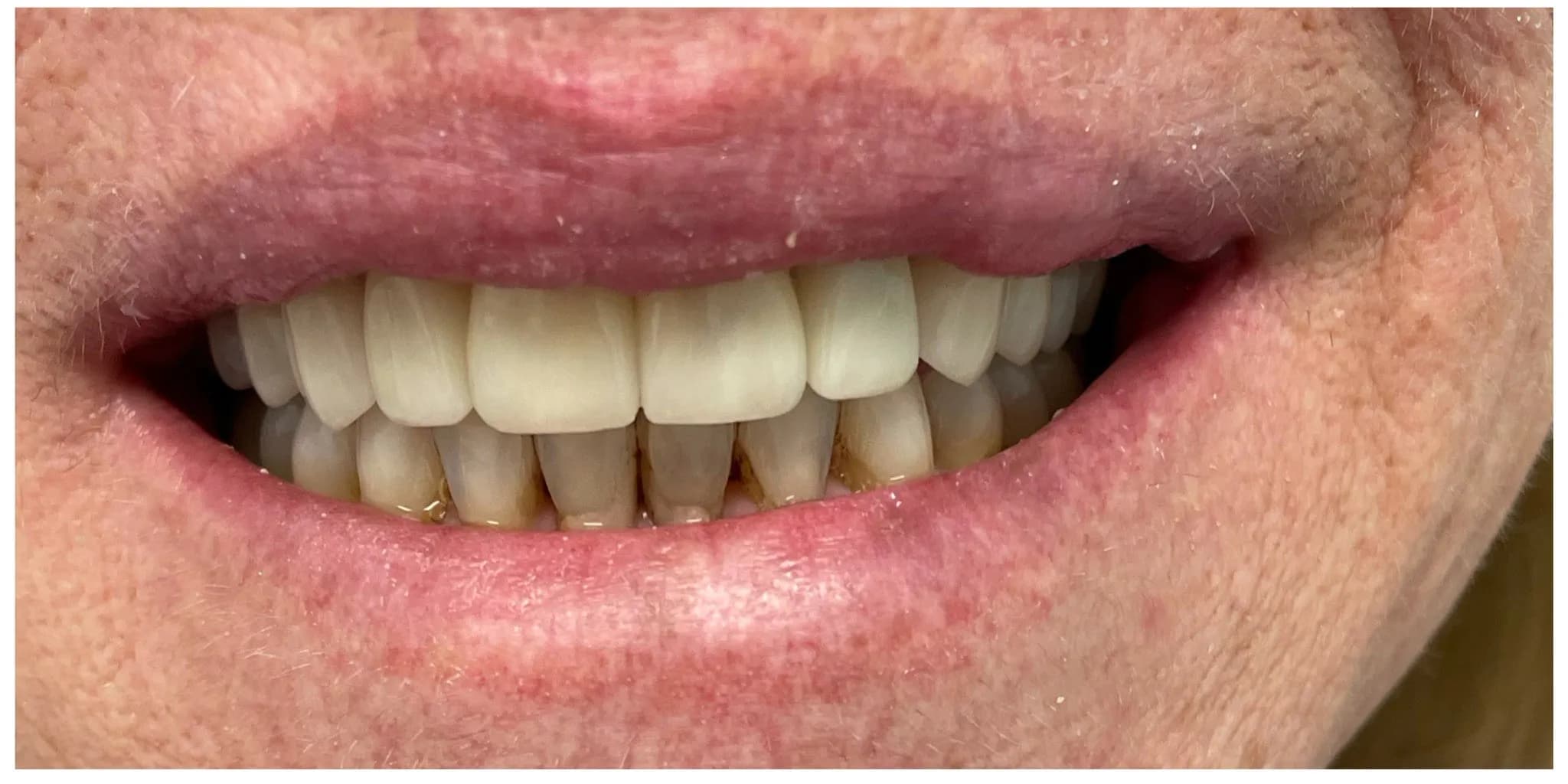 After: Invisalign Alignment