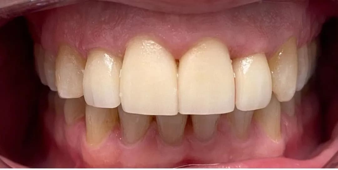 After: Porcelain Crown