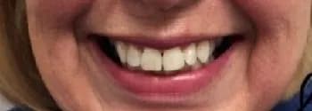 Before: Complete Smile Transformation