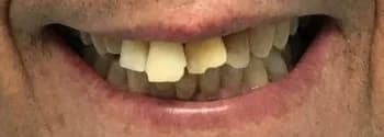 Before: Porcelain Veneers