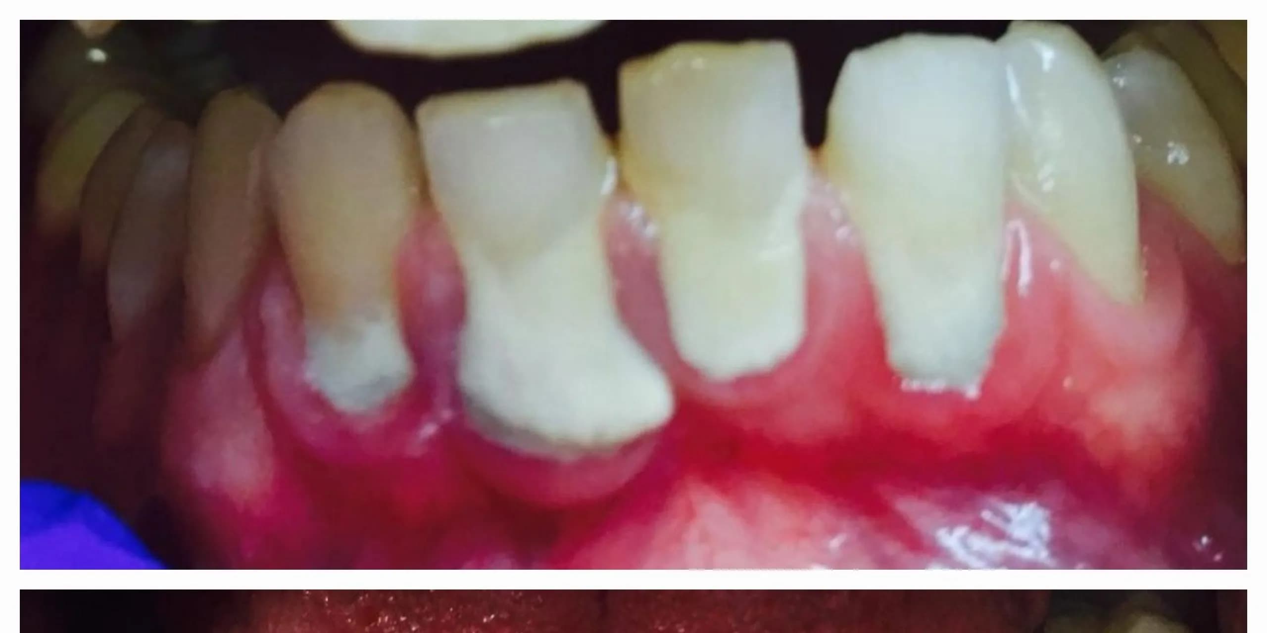 Before: Professional Dental Cleaning