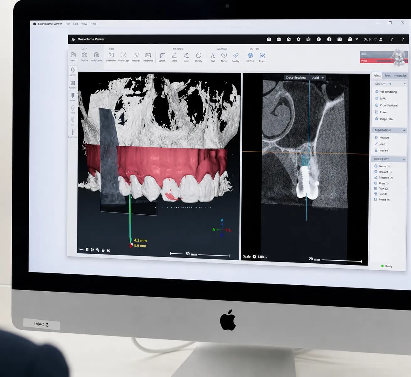 Dentist and patient reviewing digital implant treatment plan
