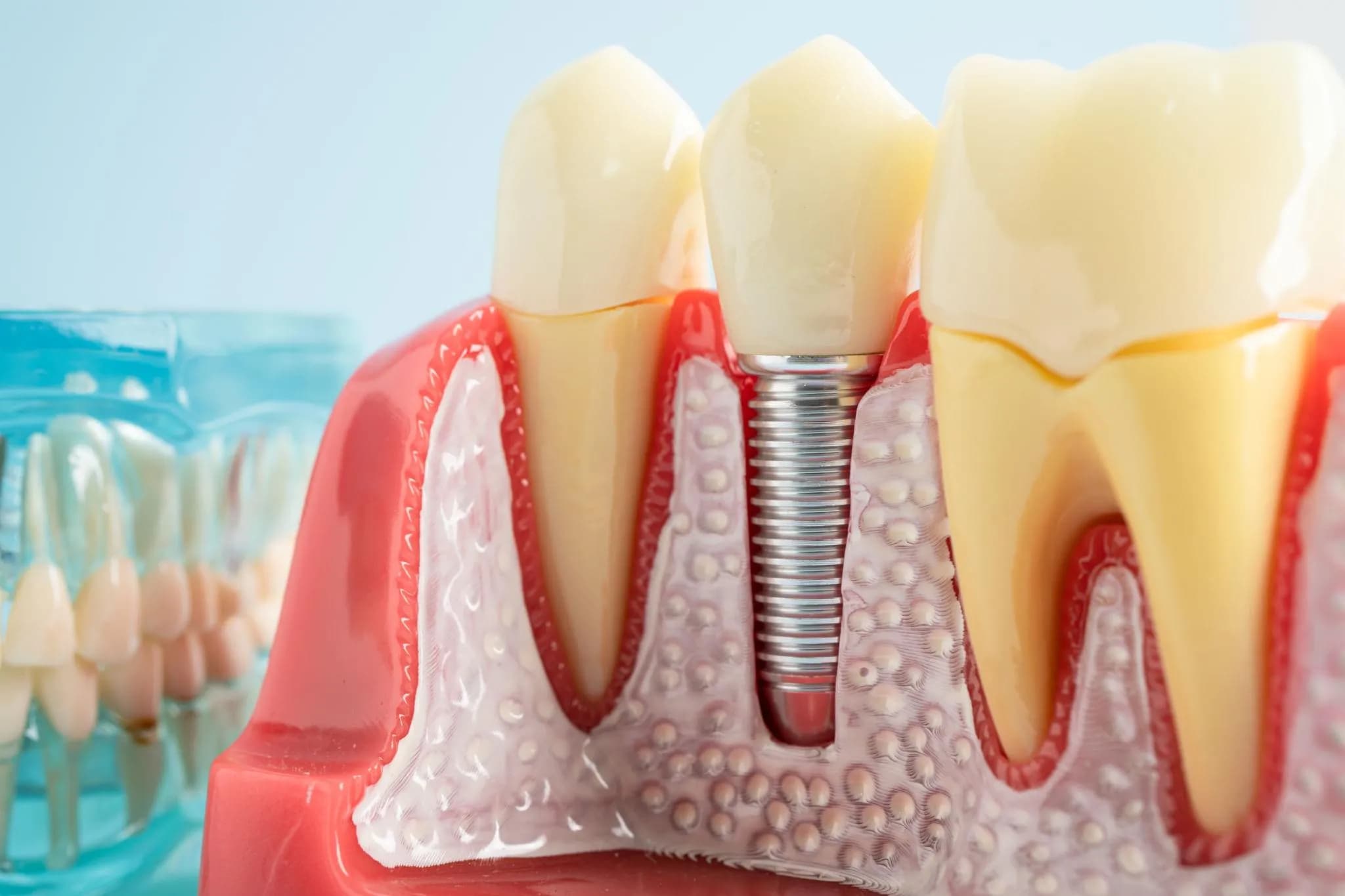 Patient smiling during the healing period after implant