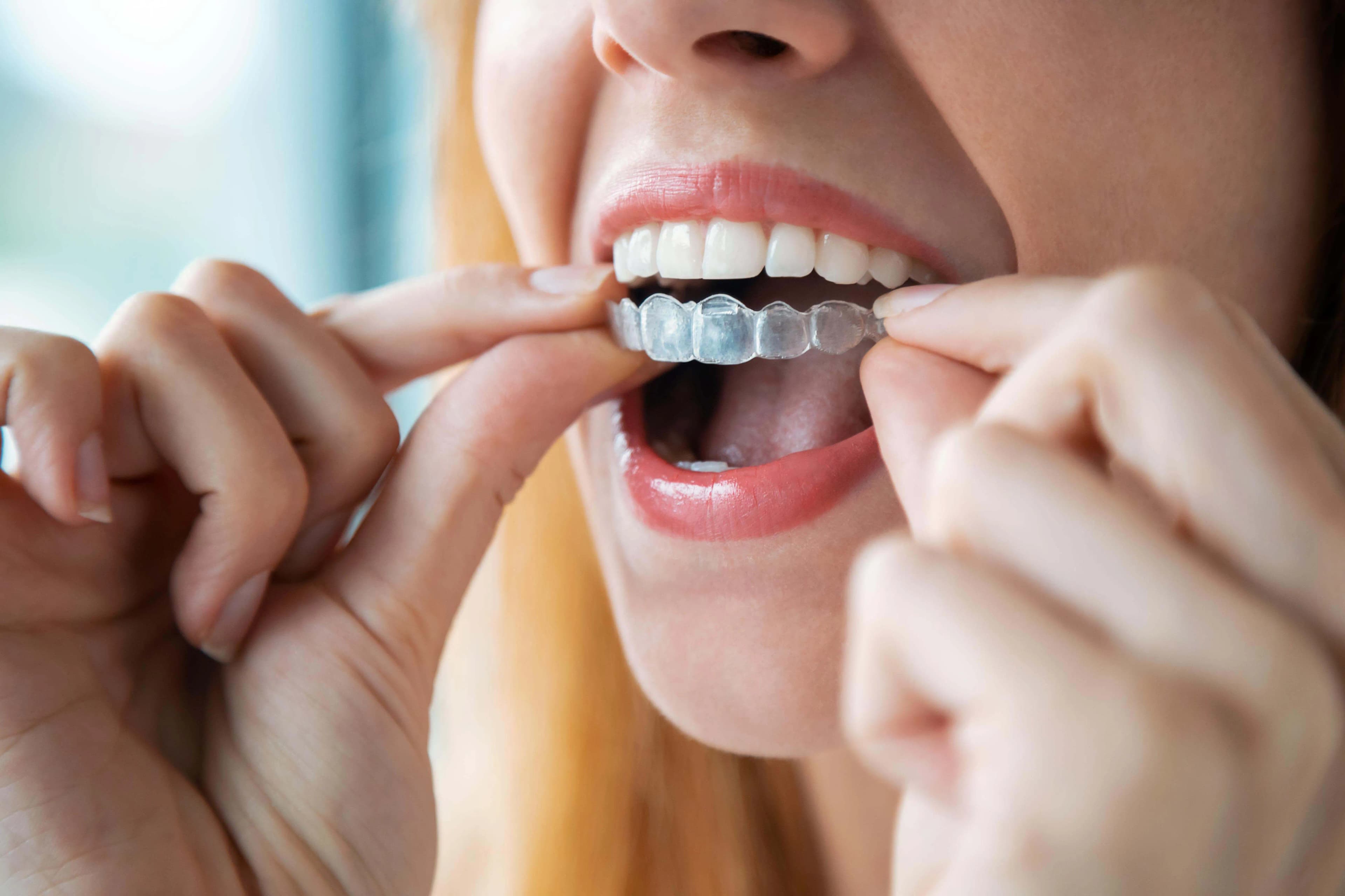 Woman smiling while wearing clear aligners