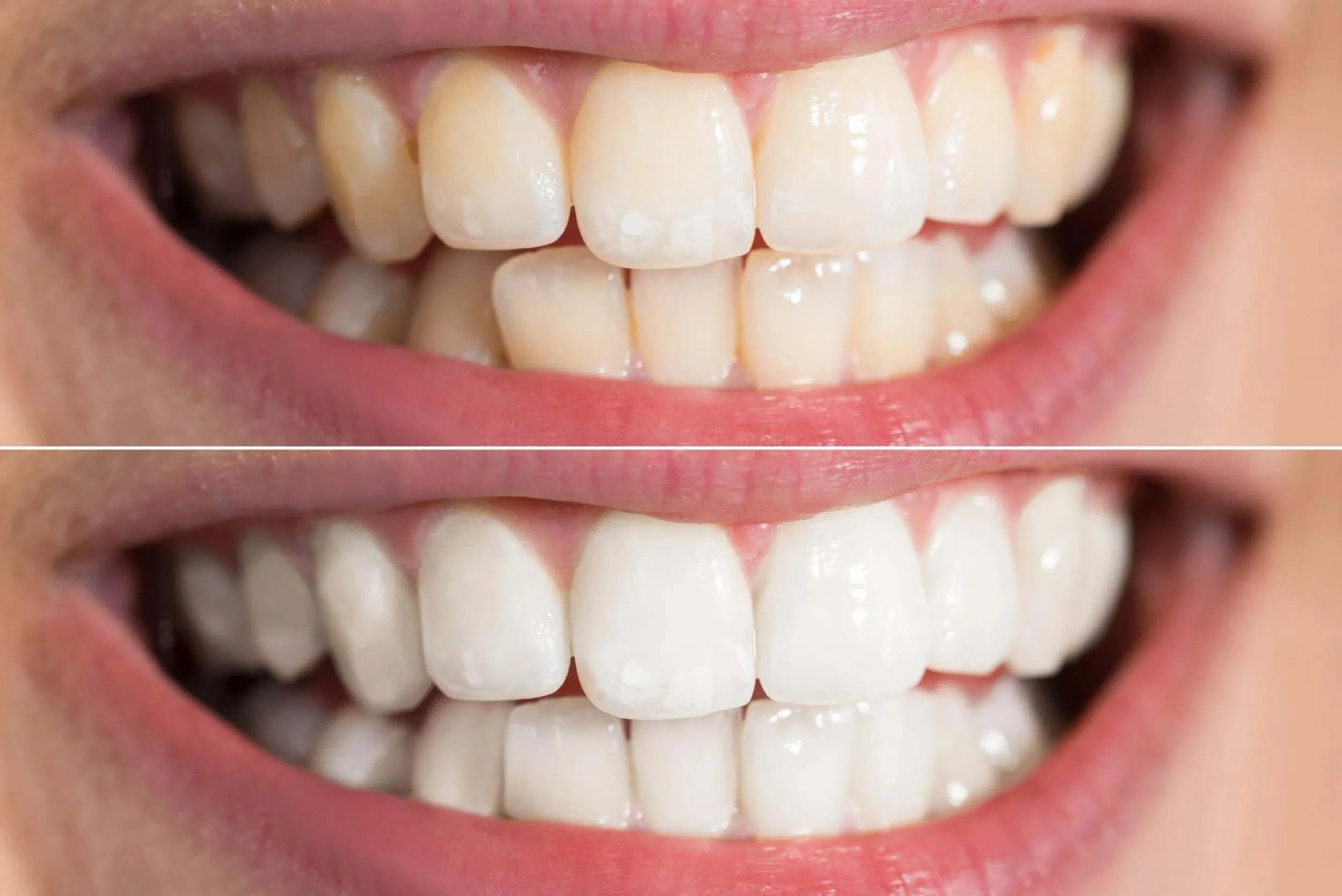 Woman with a radiant white smile after whitening treatment