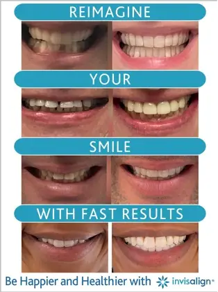 Invisalign
